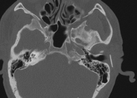 Ultrasonography to manage a unique presentation of chronic otorrhoea