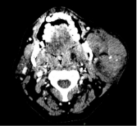 Surgical management of neck trauma with parotid haematoma in a patient with vascular Ehlers-Danlos syndrome